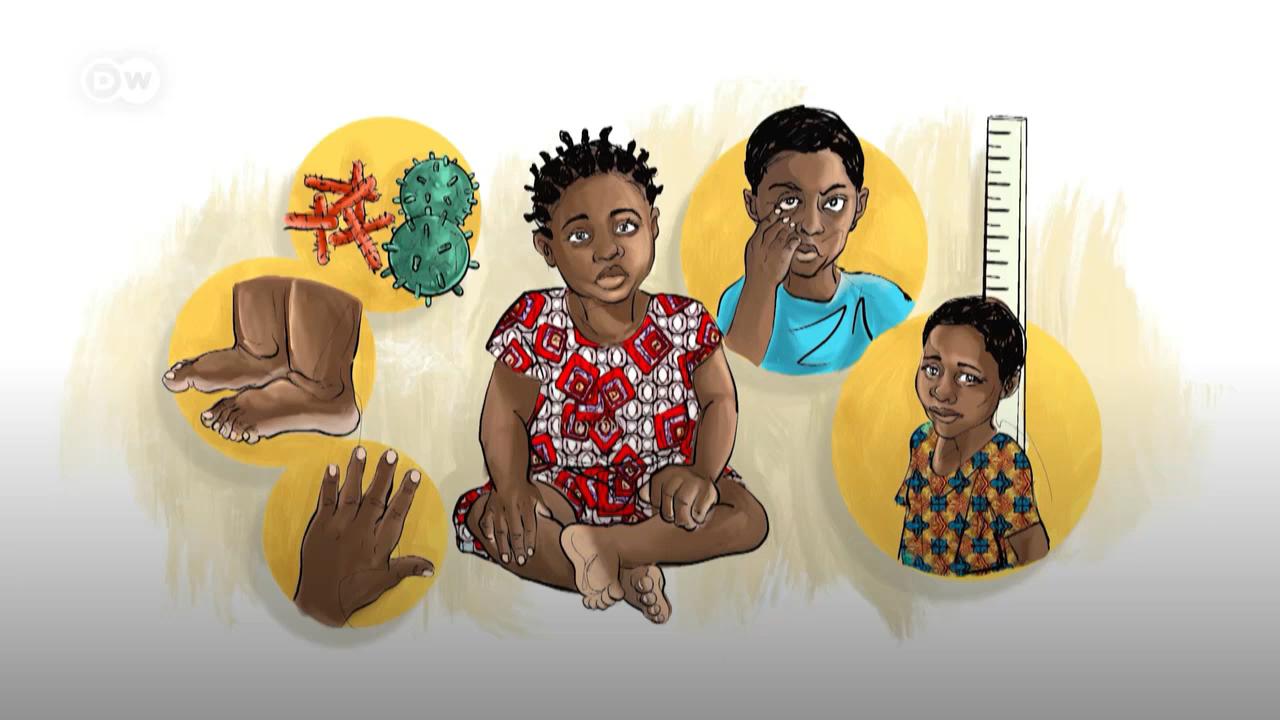 Saviez-vous que la drépanocytose touche principalement les africains ? Regardez la vidéo pour en savoir plus ! 