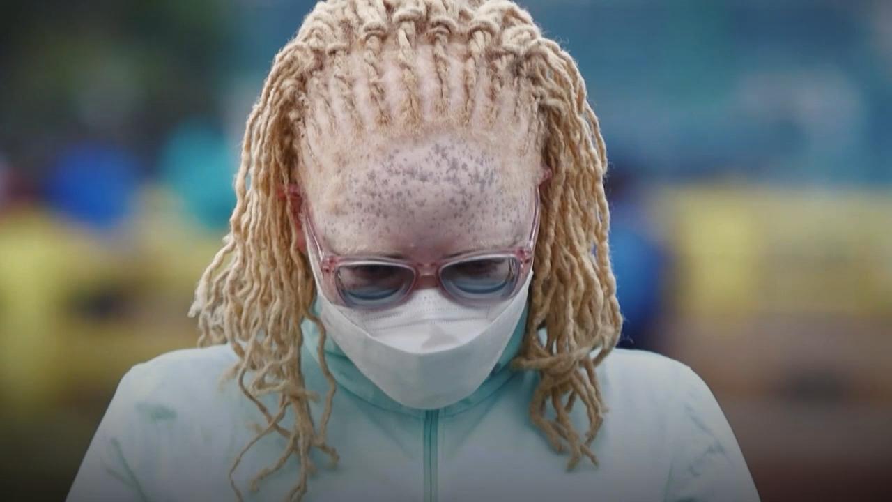 Le combat de Jane Waithera contre la stigmatisation de l'albinisme 